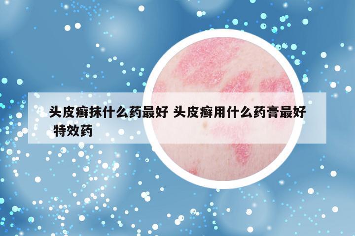 头皮癣抹什么药最好 头皮癣用什么药膏最好 特效药