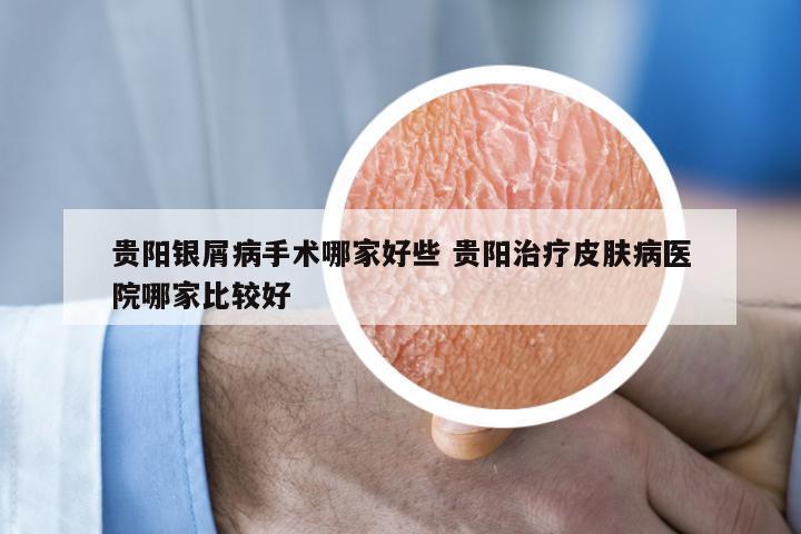贵阳银屑病手术哪家好些 贵阳治疗皮肤病医院哪家比较好