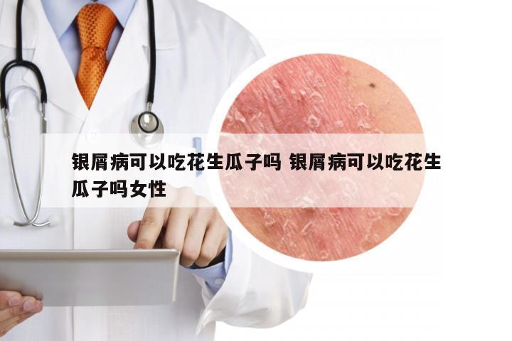 银屑病可以吃花生瓜子吗 银屑病可以吃花生瓜子吗女性