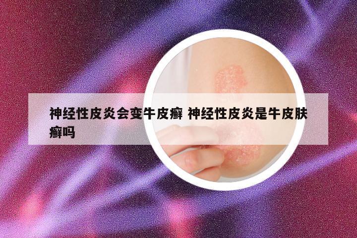 神经性皮炎会变牛皮癣 神经性皮炎是牛皮肤癣吗