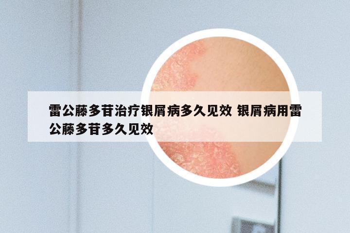 雷公藤多苷治疗银屑病多久见效 银屑病用雷公藤多苷多久见效