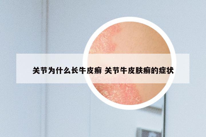 关节为什么长牛皮癣 关节牛皮肤癣的症状