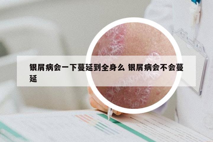 银屑病会一下蔓延到全身么 银屑病会不会蔓延