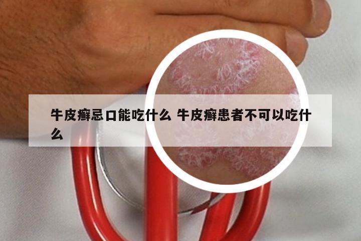 牛皮癣忌口能吃什么 牛皮癣患者不可以吃什么