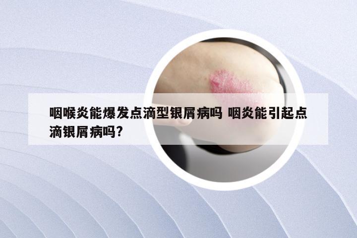 咽喉炎能爆发点滴型银屑病吗 咽炎能引起点滴银屑病吗?