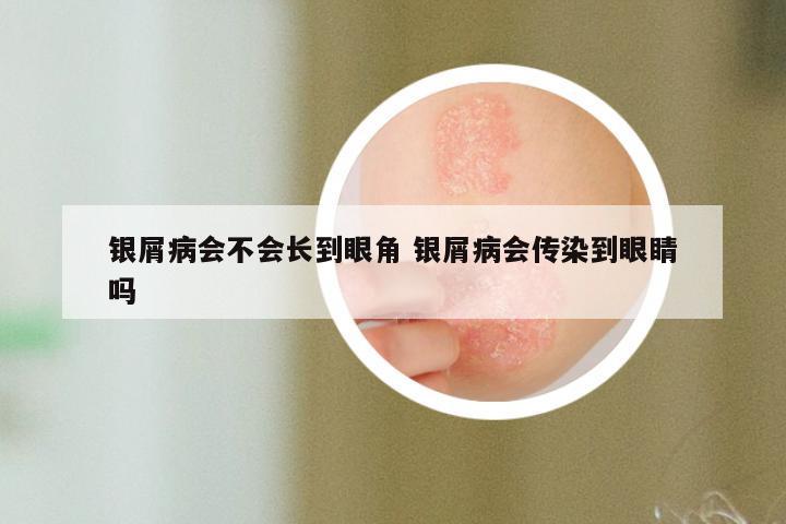 银屑病会不会长到眼角 银屑病会传染到眼睛吗