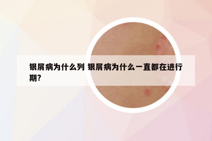 银屑病为什么列 银屑病为什么一直都在进行期?