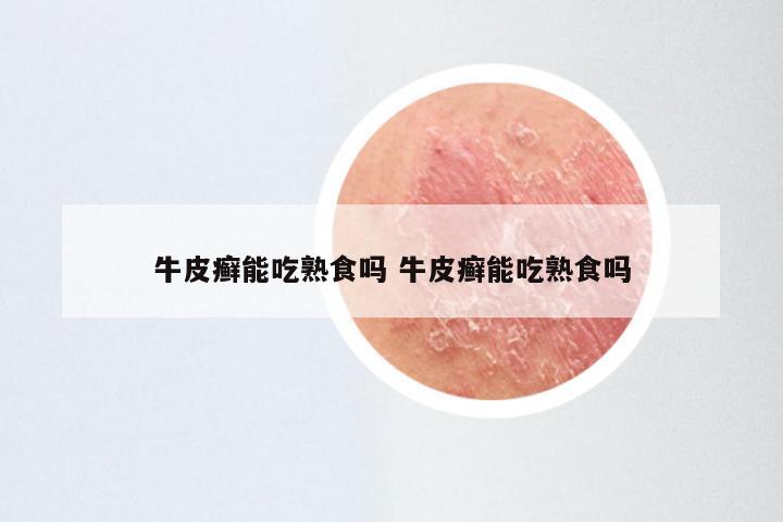 牛皮癣能吃熟食吗 牛皮癣能吃熟食吗