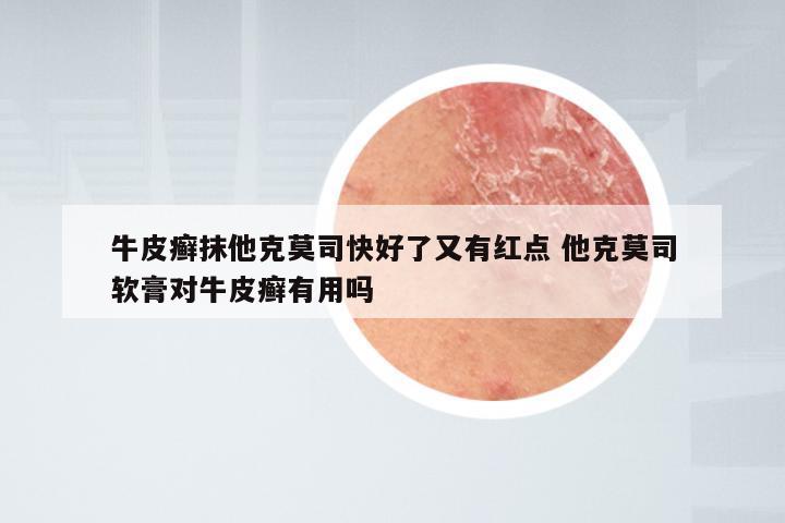 牛皮癣抹他克莫司快好了又有红点 他克莫司软膏对牛皮癣有用吗