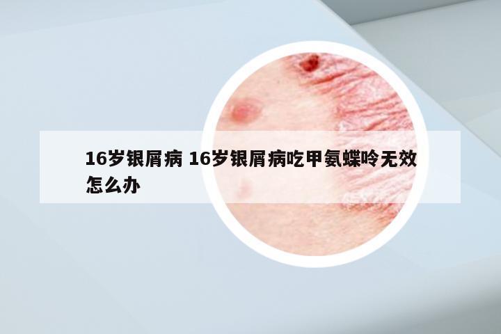 16岁银屑病 16岁银屑病吃甲氨蝶呤无效怎么办