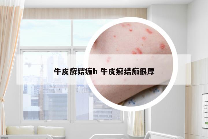 牛皮癣结痂h 牛皮癣结痂很厚
