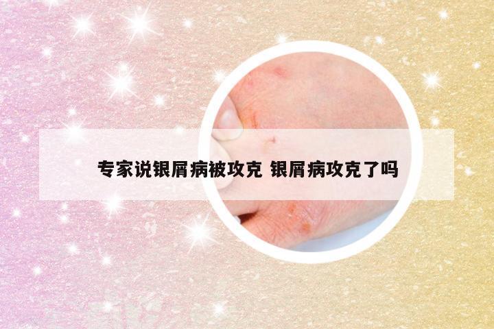 专家说银屑病被攻克 银屑病攻克了吗