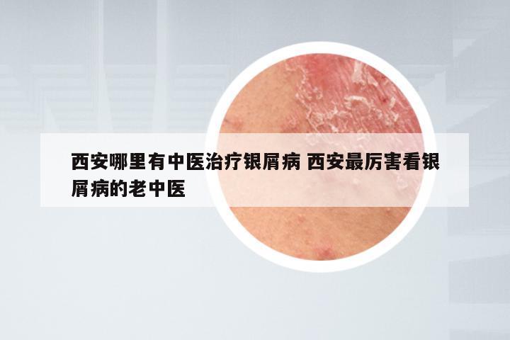 西安哪里有中医治疗银屑病 西安最厉害看银屑病的老中医