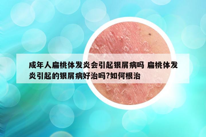 成年人扁桃体发炎会引起银屑病吗 扁桃体发炎引起的银屑病好治吗?如何根治