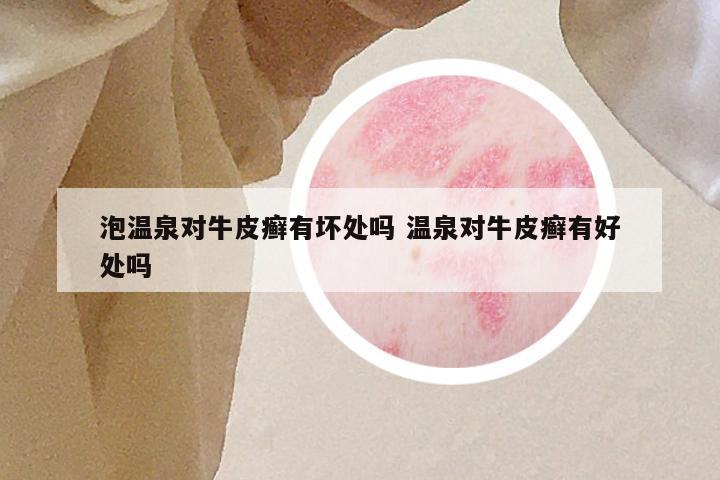 泡温泉对牛皮癣有坏处吗 温泉对牛皮癣有好处吗