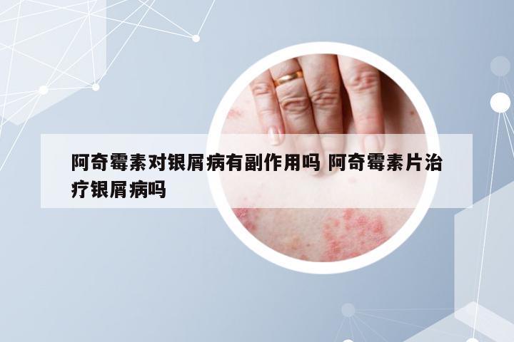 阿奇霉素对银屑病有副作用吗 阿奇霉素片治疗银屑病吗