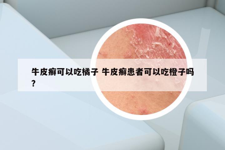 牛皮癣可以吃橘子 牛皮癣患者可以吃橙子吗?