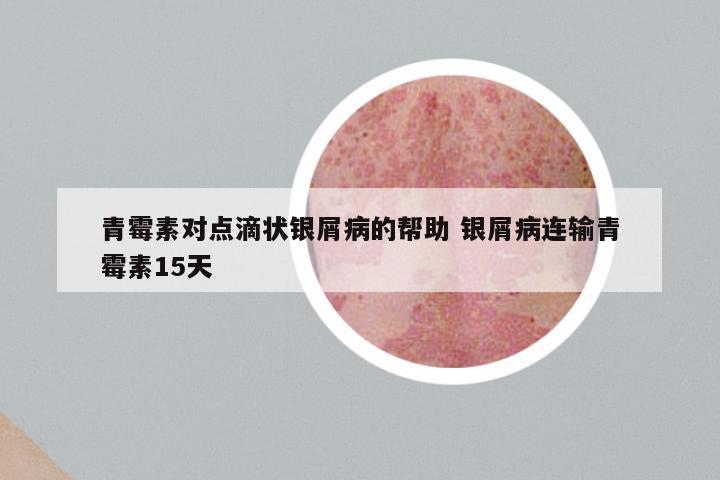 青霉素对点滴状银屑病的帮助 银屑病连输青霉素15天
