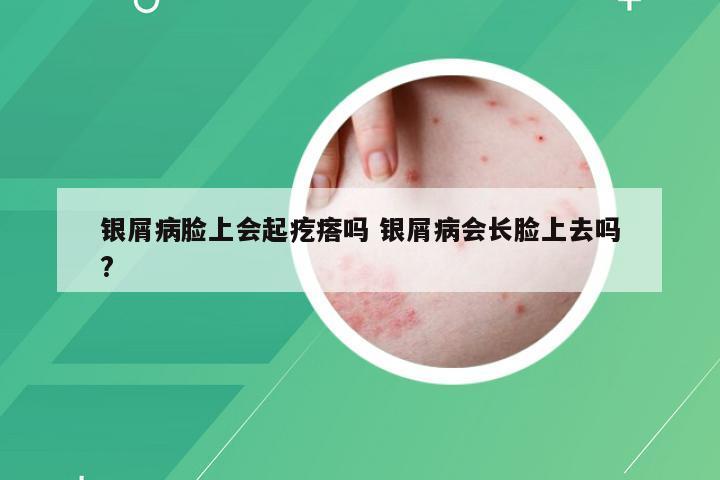 银屑病脸上会起疙瘩吗 银屑病会长脸上去吗?
