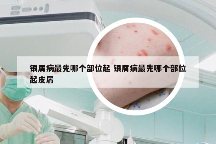 银屑病最先哪个部位起 银屑病最先哪个部位起皮屑