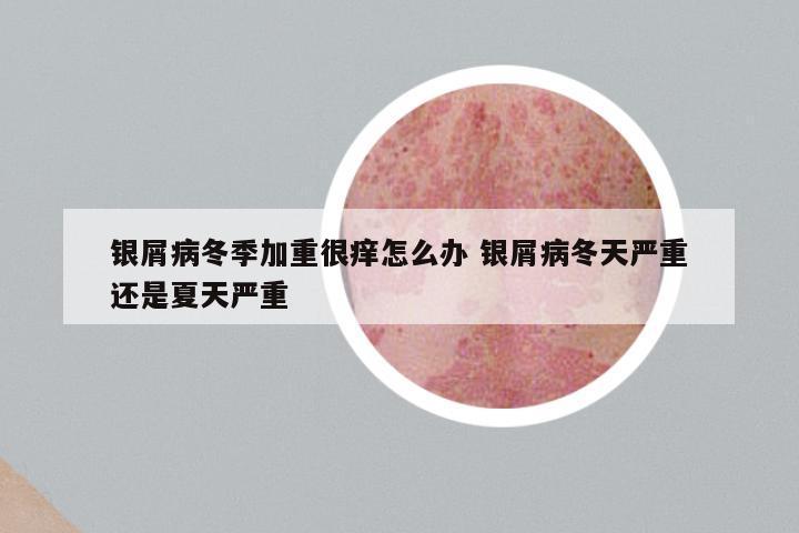 银屑病冬季加重很痒怎么办 银屑病冬天严重还是夏天严重