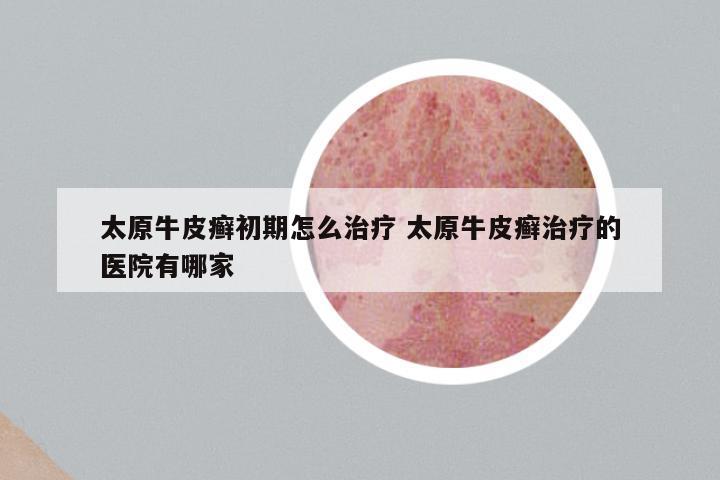 太原牛皮癣初期怎么治疗 太原牛皮癣治疗的医院有哪家