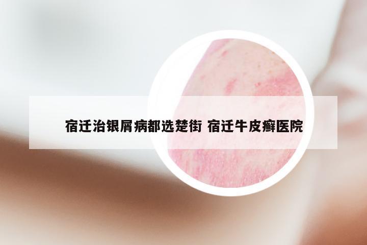 宿迁治银屑病都选楚街 宿迁牛皮癣医院