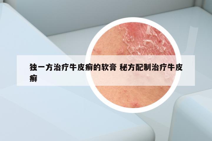 独一方治疗牛皮癣的软膏 秘方配制治疗牛皮癣