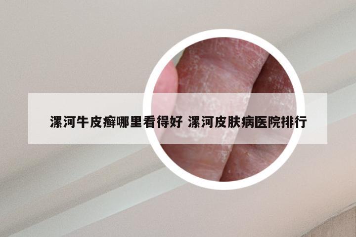 漯河牛皮癣哪里看得好 漯河皮肤病医院排行