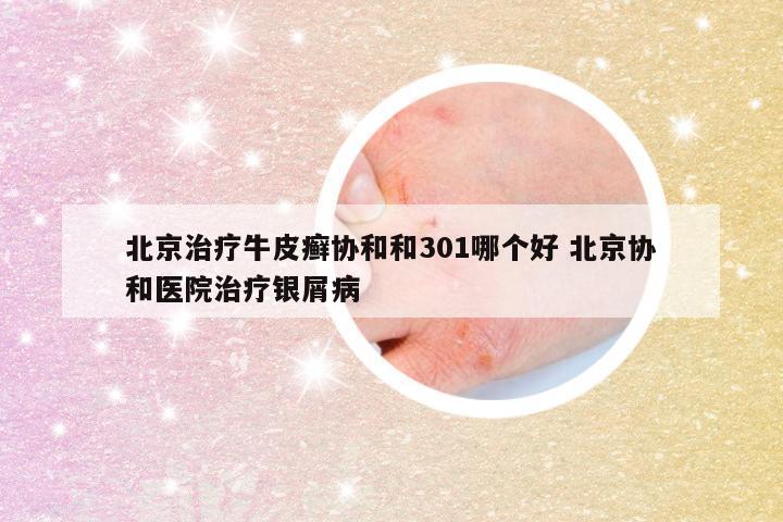 北京治疗牛皮癣协和和301哪个好 北京协和医院治疗银屑病
