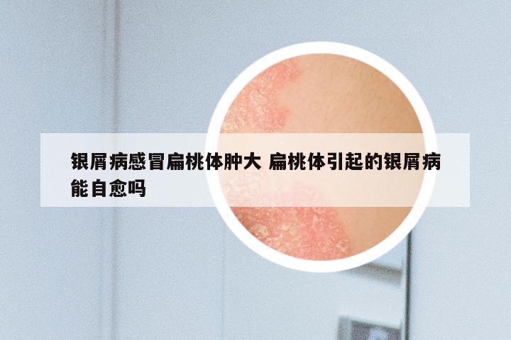 银屑病感冒扁桃体肿大 扁桃体引起的银屑病能自愈吗