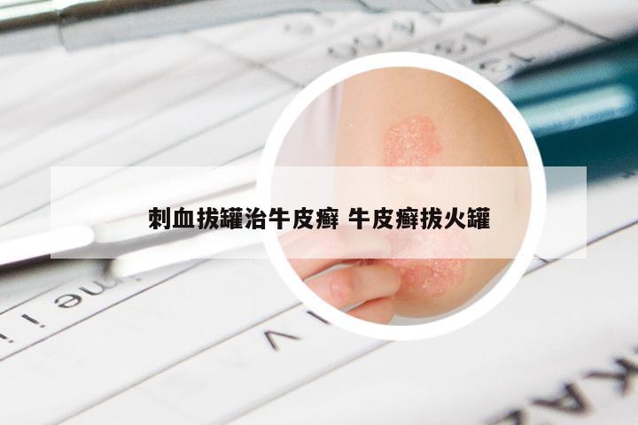刺血拔罐治牛皮癣 牛皮癣拔火罐