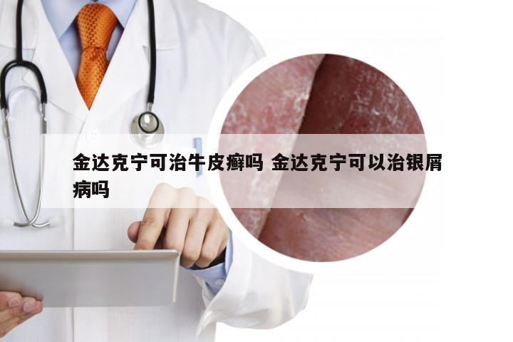 金达克宁可治牛皮癣吗 金达克宁可以治银屑病吗