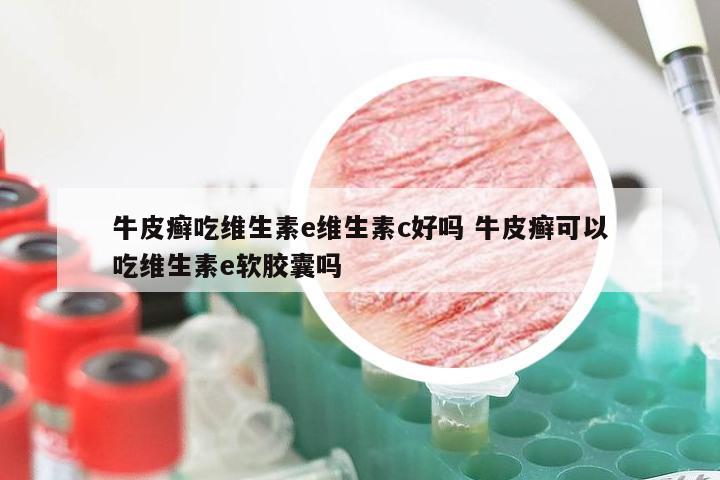 牛皮癣吃维生素e维生素c好吗 牛皮癣可以吃维生素e软胶囊吗
