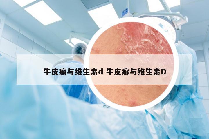 牛皮癣与维生素d 牛皮癣与维生素D