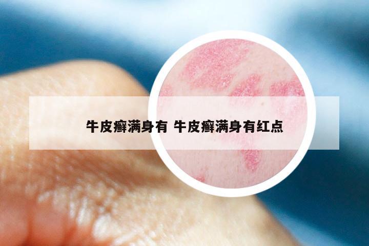 牛皮癣满身有 牛皮癣满身有红点