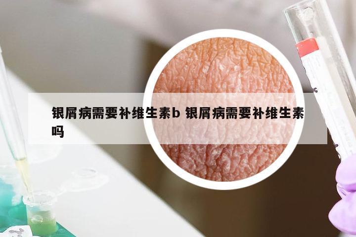 银屑病需要补维生素b 银屑病需要补维生素吗