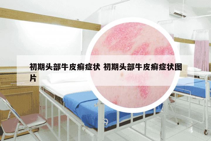 初期头部牛皮癣症状 初期头部牛皮癣症状图片