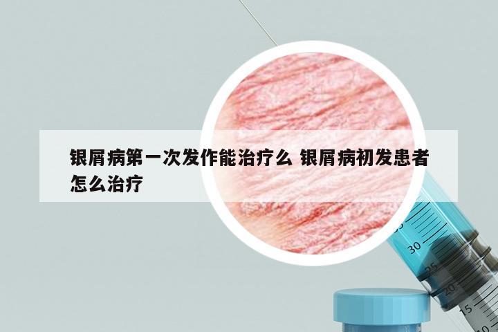 银屑病第一次发作能治疗么 银屑病初发患者怎么治疗