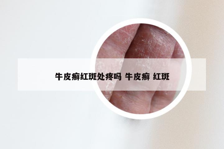 牛皮癣红斑处疼吗 牛皮癣 红斑
