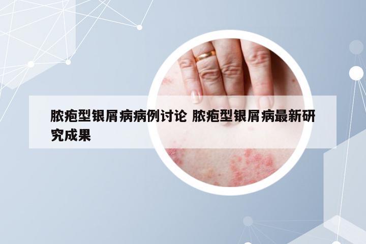 脓疱型银屑病病例讨论 脓疱型银屑病最新研究成果