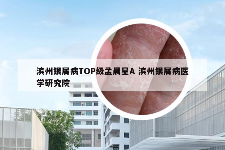 滨州银屑病TOP级孟晨星A 滨州银屑病医学研究院