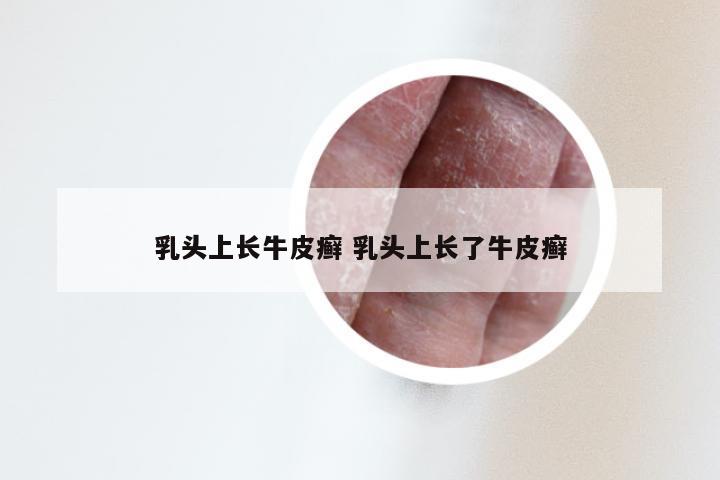 乳头上长牛皮癣 乳头上长了牛皮癣