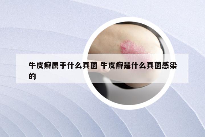 牛皮癣属于什么真菌 牛皮癣是什么真菌感染的