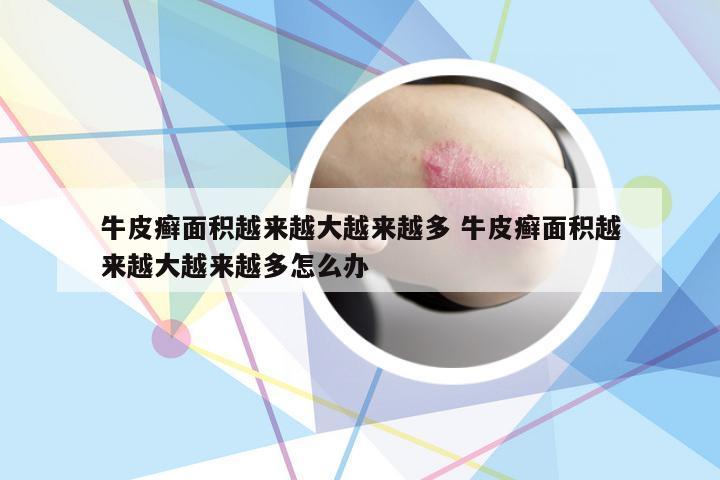 牛皮癣面积越来越大越来越多 牛皮癣面积越来越大越来越多怎么办