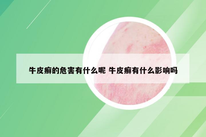 牛皮癣的危害有什么呢 牛皮癣有什么影响吗