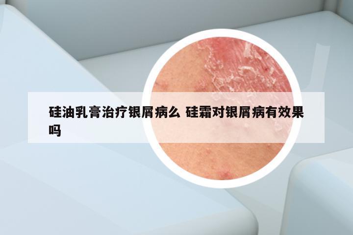 硅油乳膏治疗银屑病么 硅霜对银屑病有效果吗
