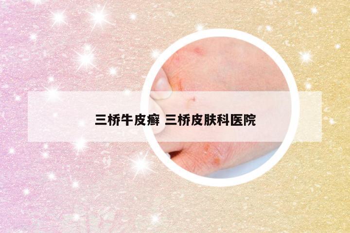 三桥牛皮癣 三桥皮肤科医院