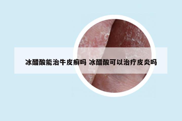 冰醋酸能治牛皮癣吗 冰醋酸可以治疗皮炎吗