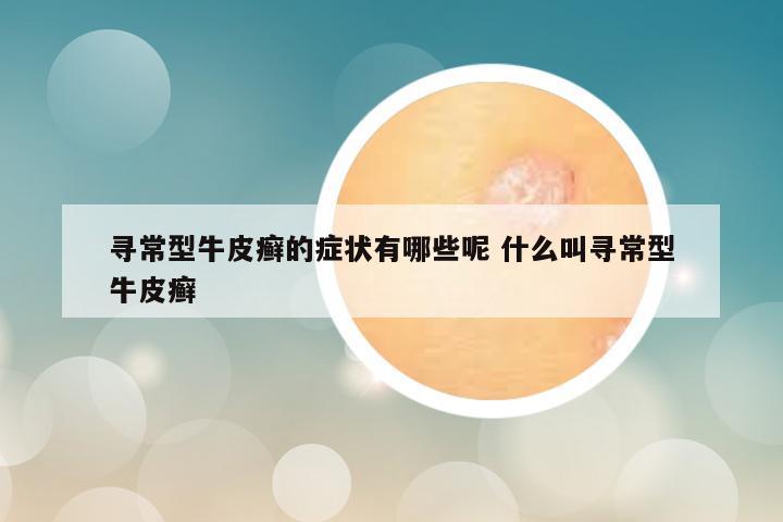 寻常型牛皮癣的症状有哪些呢 什么叫寻常型牛皮癣